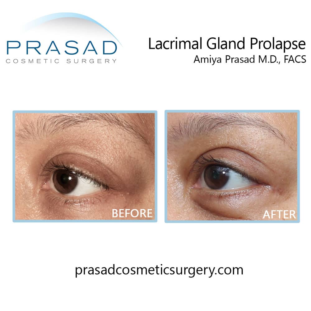 lacrimal gland prolapse before and after procedure performed by Dr. Amiya Prasad
