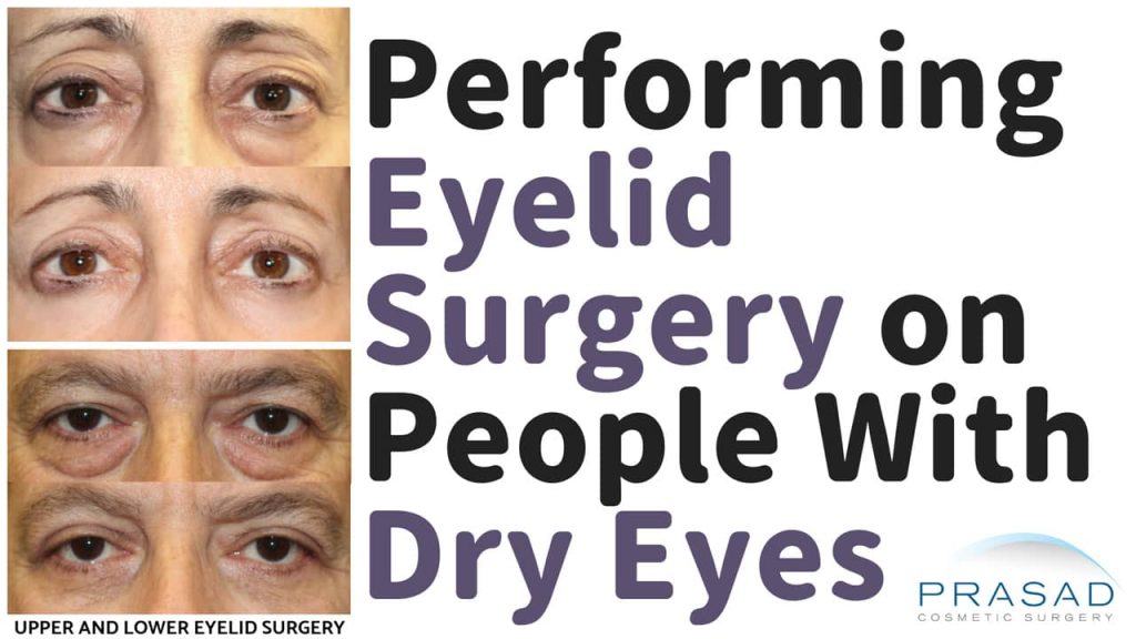 performing eyelid surgery on people with dry eyes