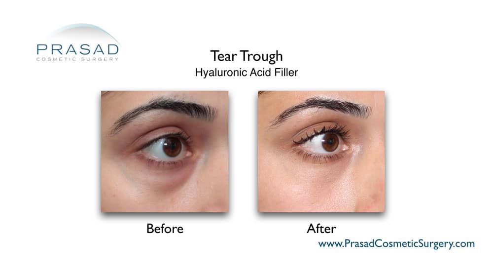 Under Eye Bag Laser Treatment