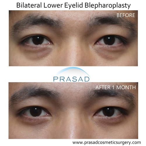 Under Eye Bag Surgery | Prasad Cosmetic Surgery New York