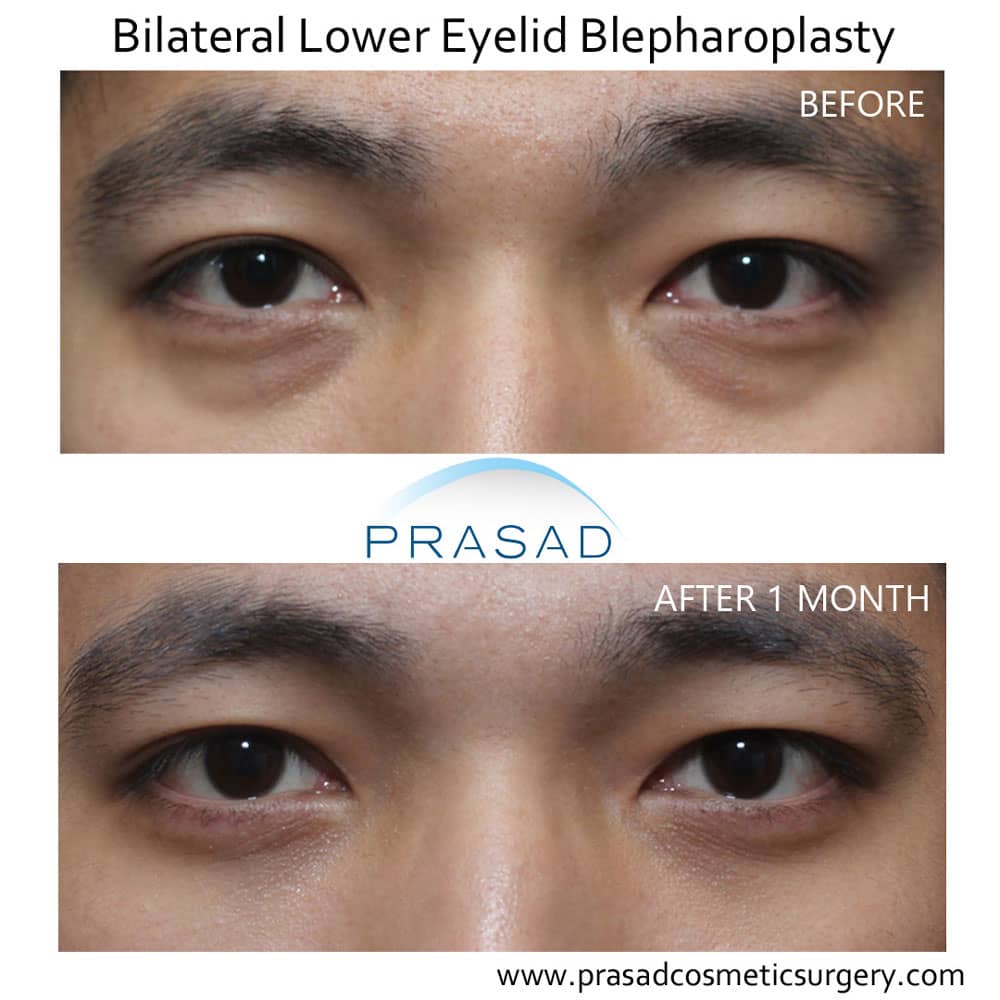 bags under eyes treatment surgery (lower blepharoplasty) recovery after 1 month