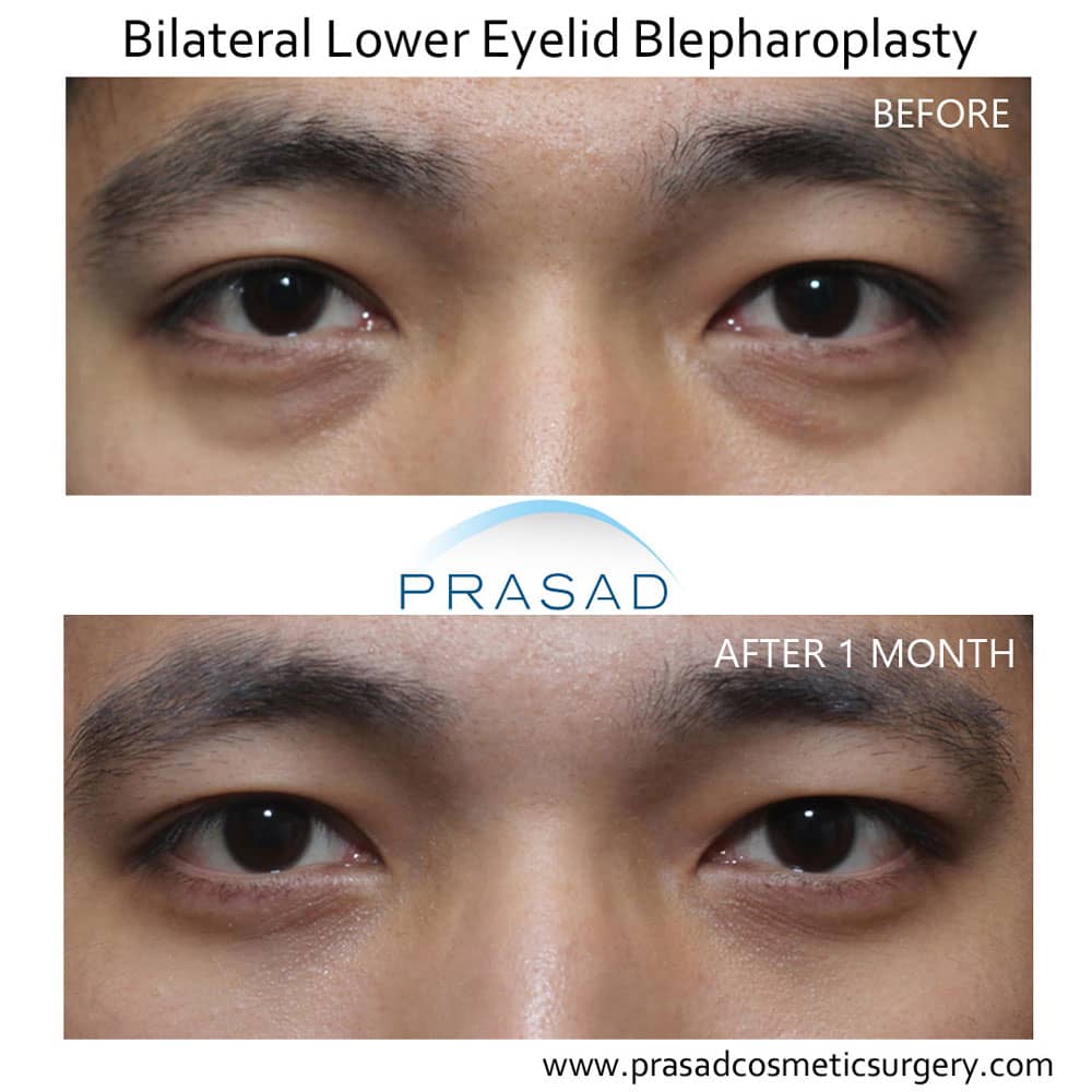 Lower eye bags: Too little or too much fat?