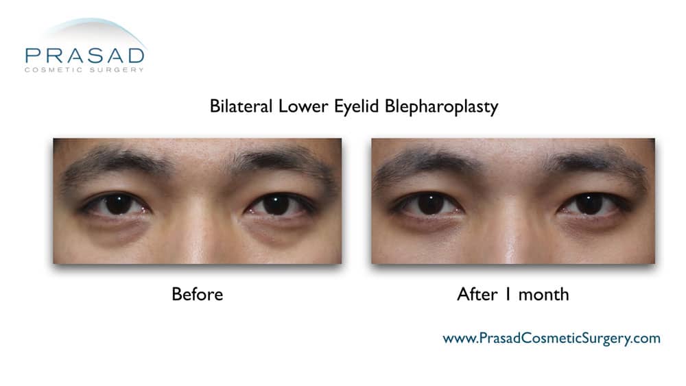 bags under eyes treatment options: surgery (lower blepharoplasty) recovery after 1 month
