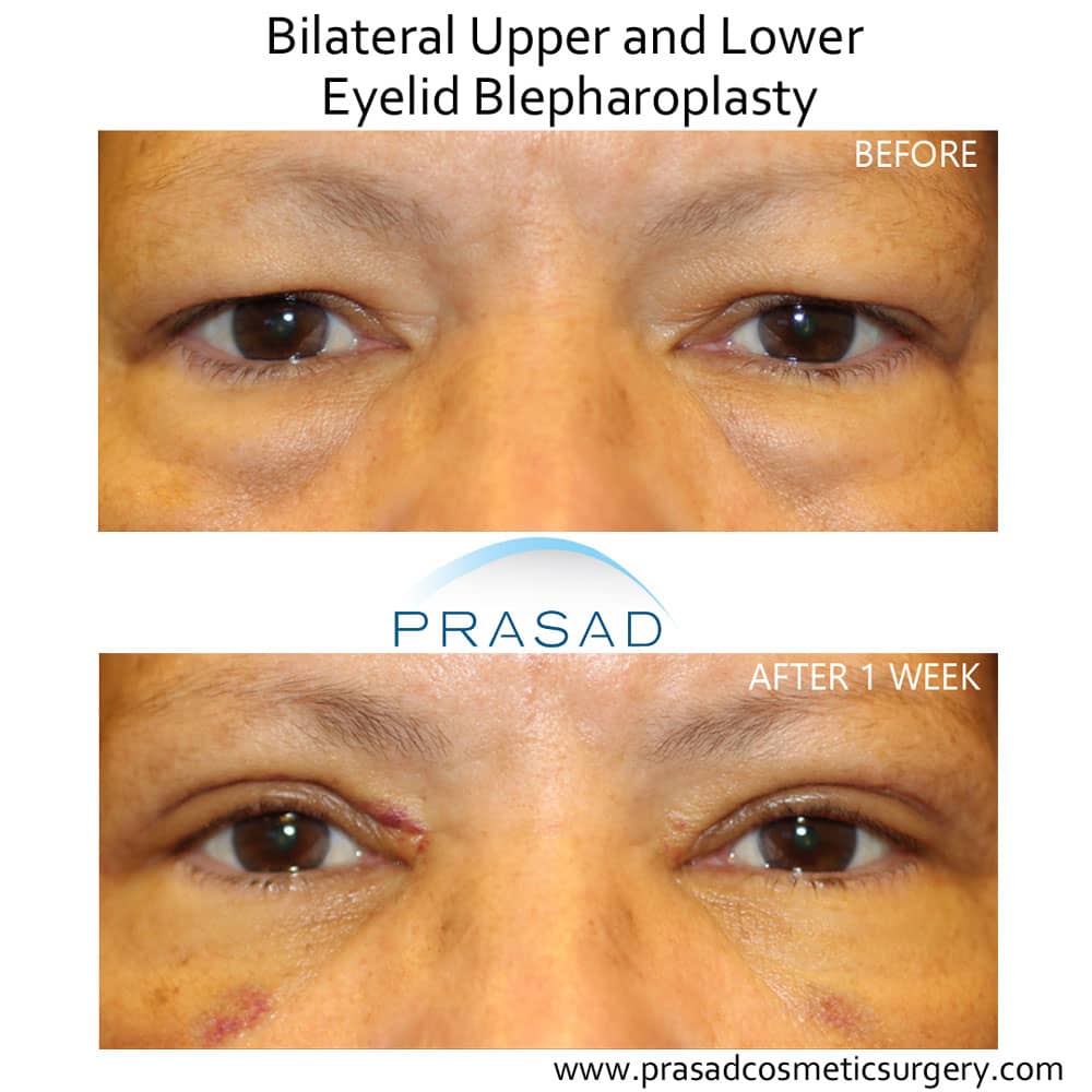 upper and lower blepharoplasty - eye bag surgery recovery after 1 week