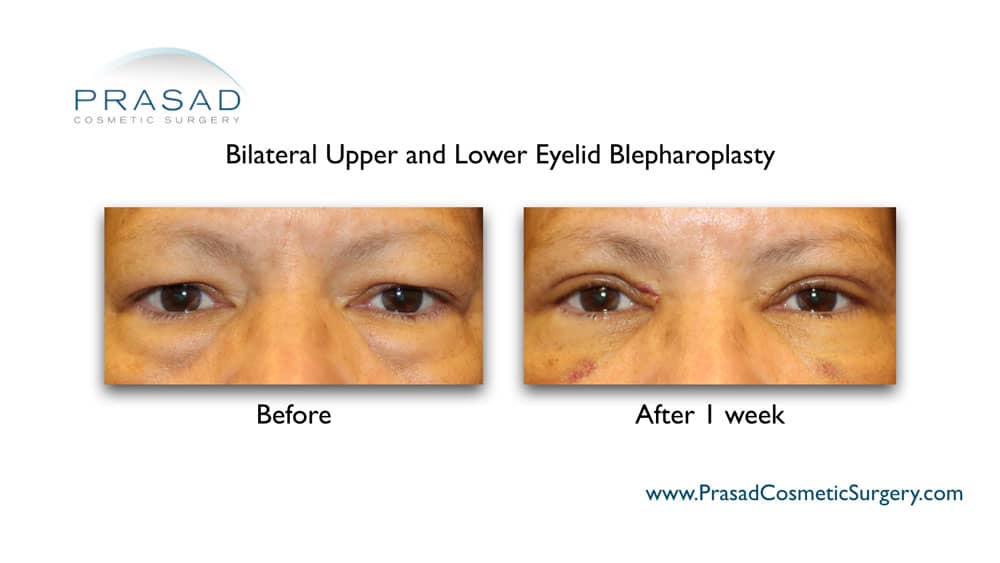 upper and lower eyelid surgery for dry eyes before and after 1 week recovery