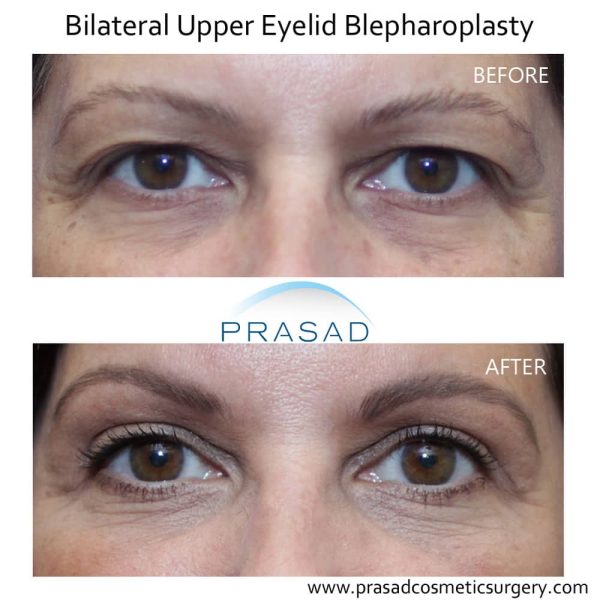 Can You Have Eyelid Surgery if You Have Dry Eyes? - Dr. Prasad Blog