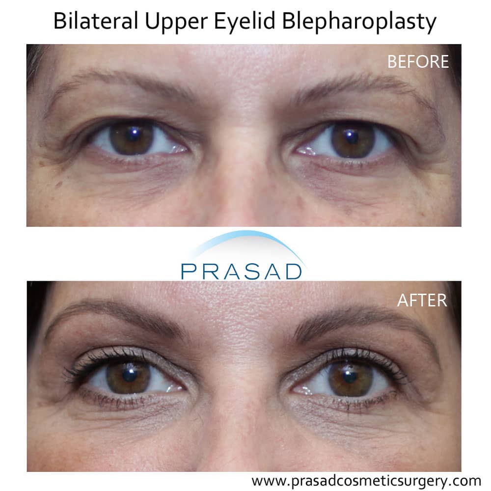 upper eyelid blepharoplasty for dry eyes before and after