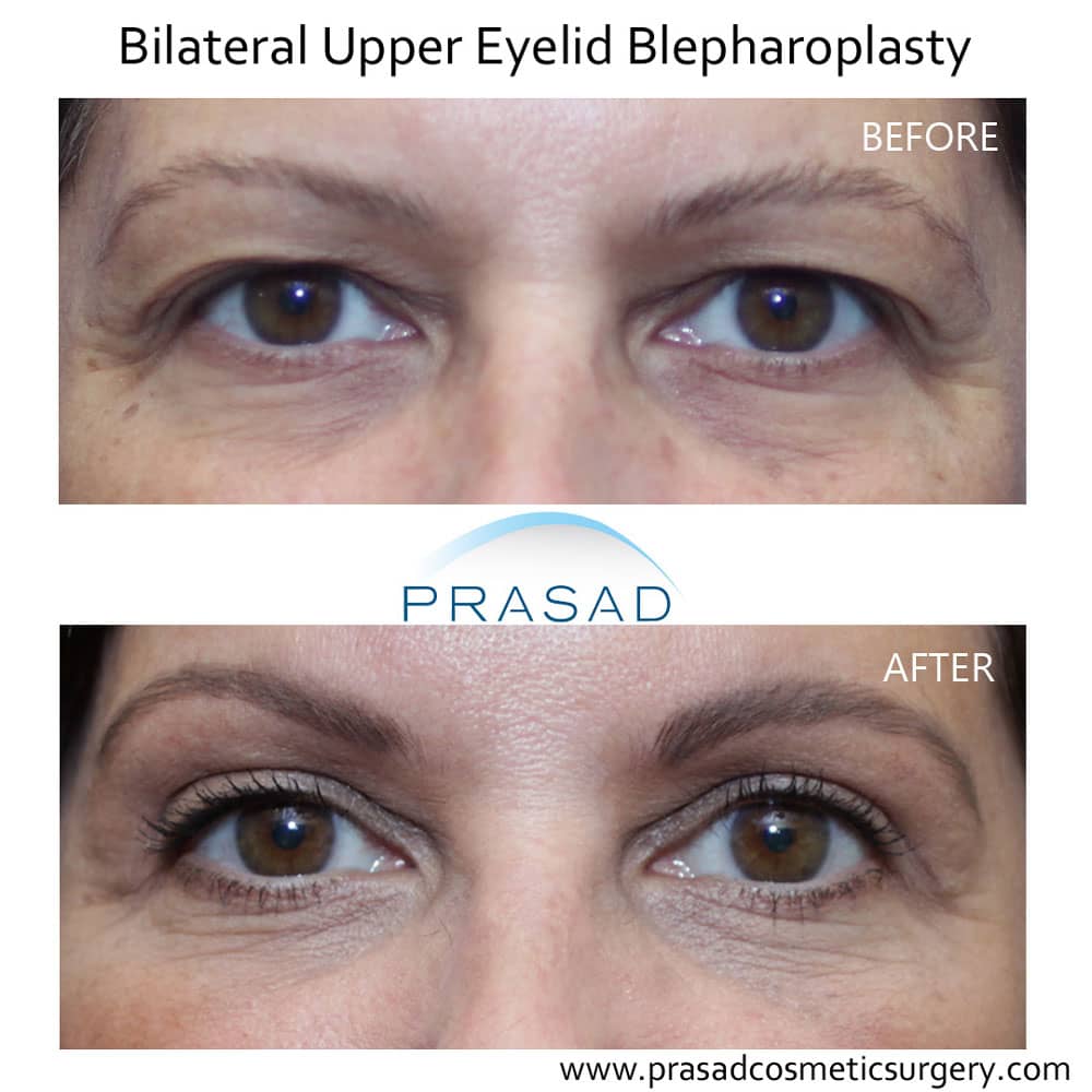 Can You Have Eyelid Surgery If You Have Dry Eyes Dr Prasad Blog   Upper Eyelid Blepharoplasty Before And After 1 