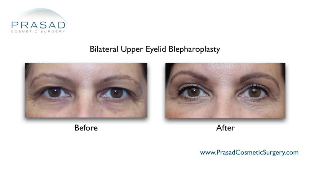 upper eyelid surgery for dry eyes before and after results