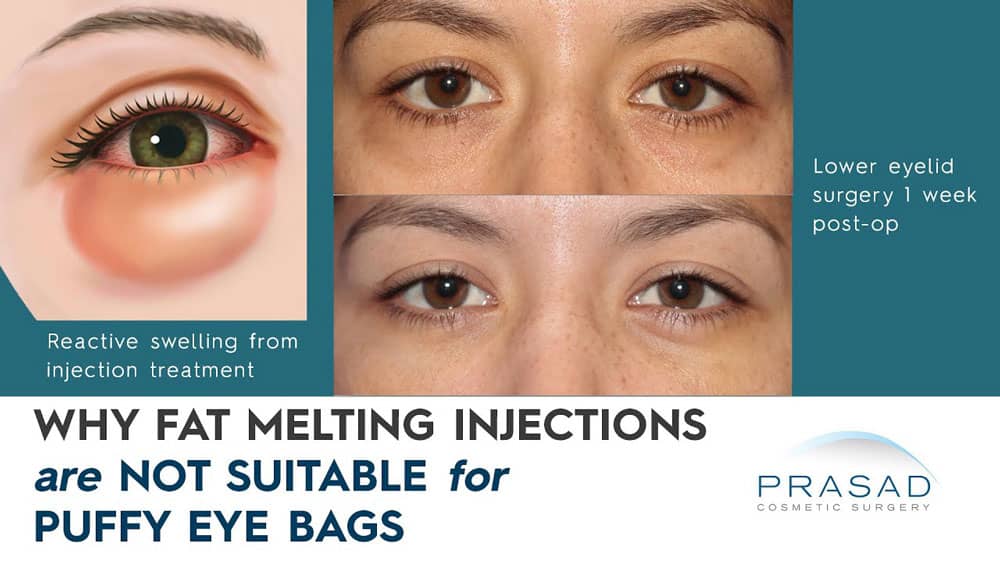 why fat dissolving injections are not suitable for bags under eyes