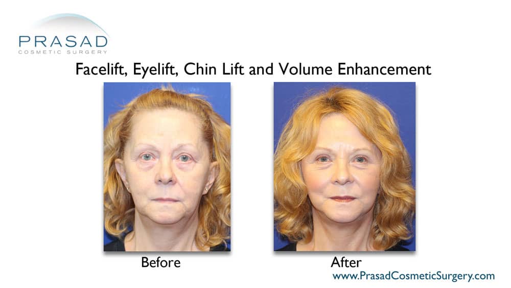 facelift surgery combined with other procedures before and after recovery