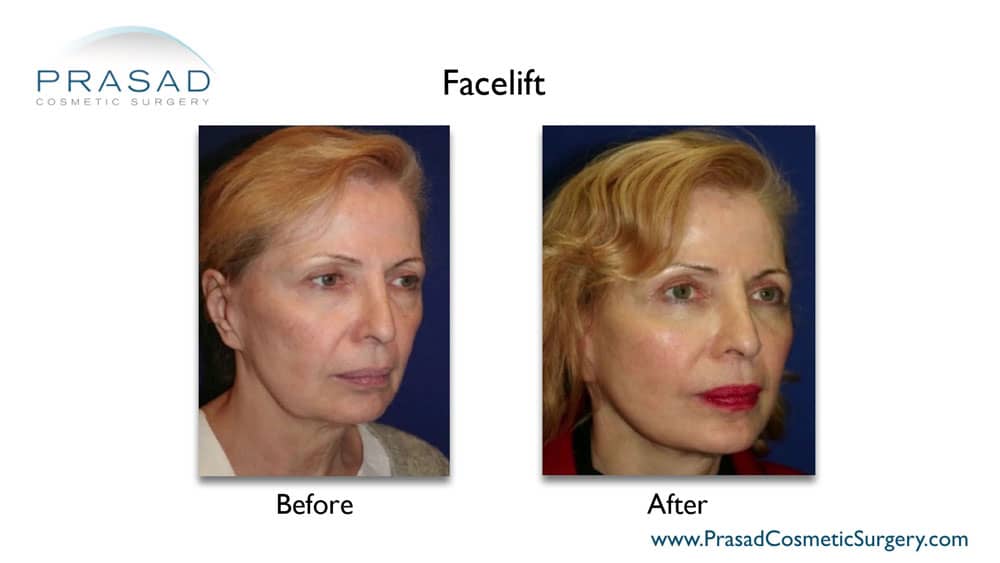 facelift done under local anesthesia - before and after