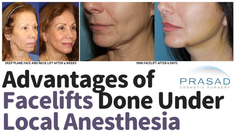 facelift done under local anesthesia