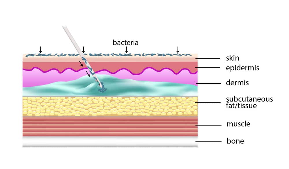 bacterial infection illustration - biofilm