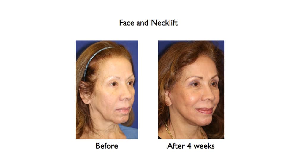 facelift and necklift recovery before and after 4 weeks