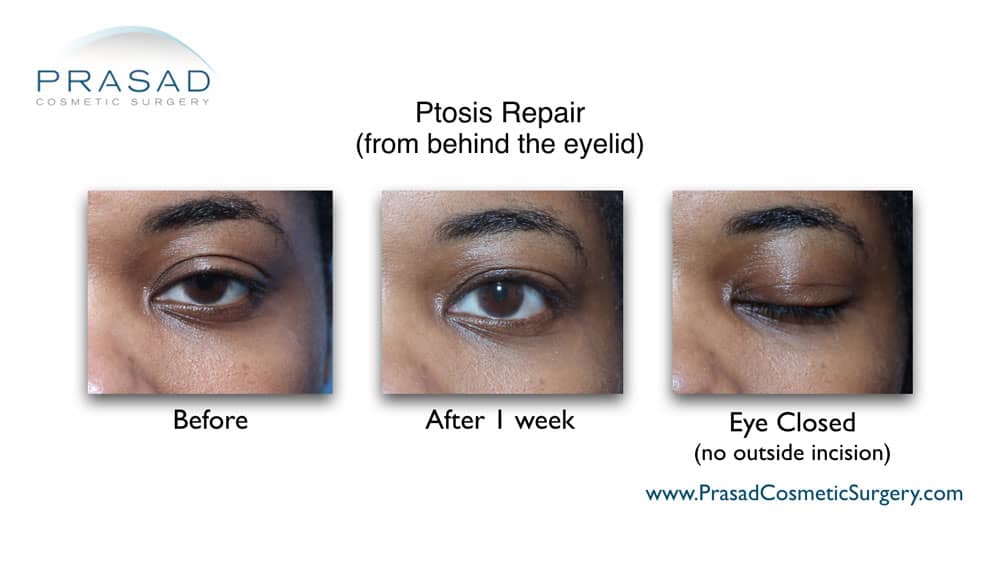 Droopy eyelid surgery clearance recovery time