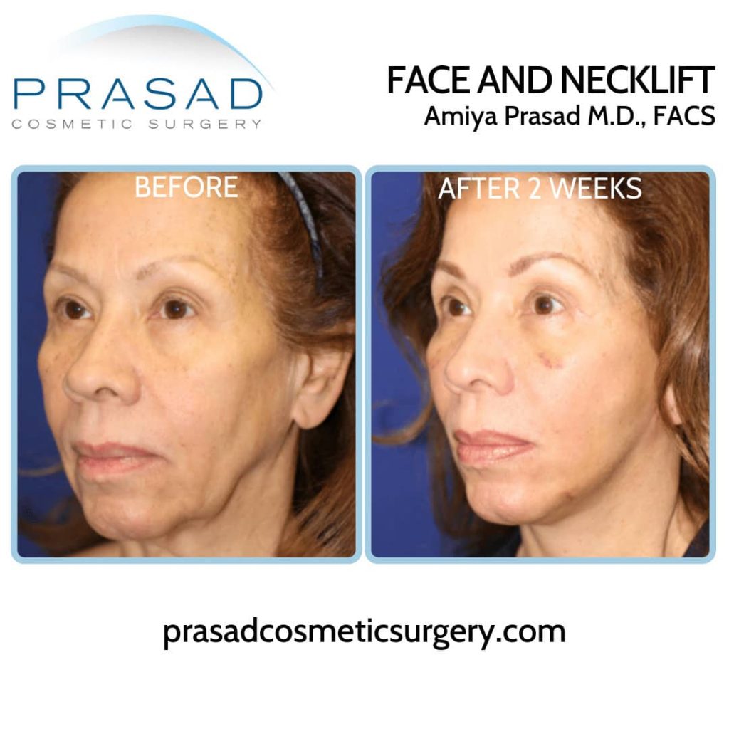 facelift recovery after two weeeks - how long do facelift last