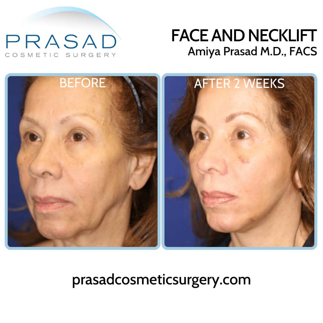 facelift recovery after two weeks