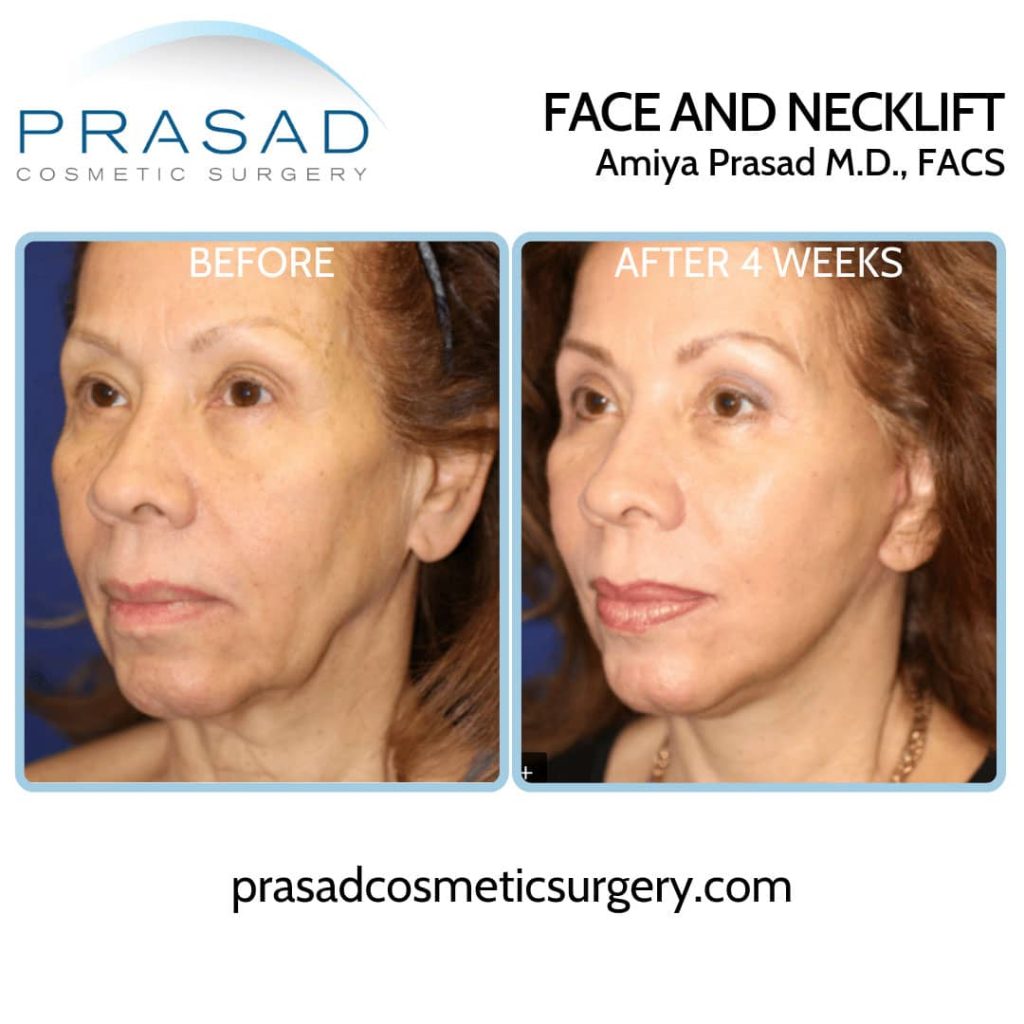 facelift surgery recovery before and after 4 weeks