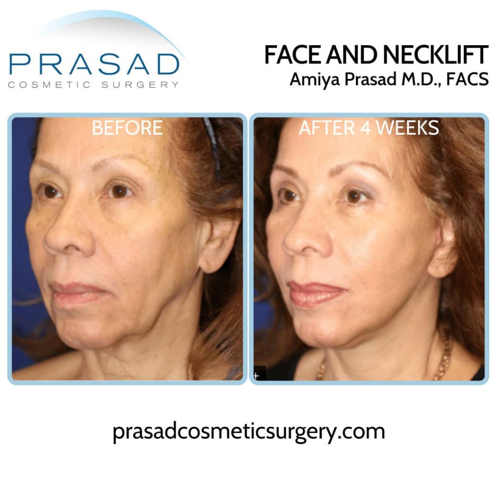 Y Lift® Non-Surgical Facelift - Dr. Amiya Prasad