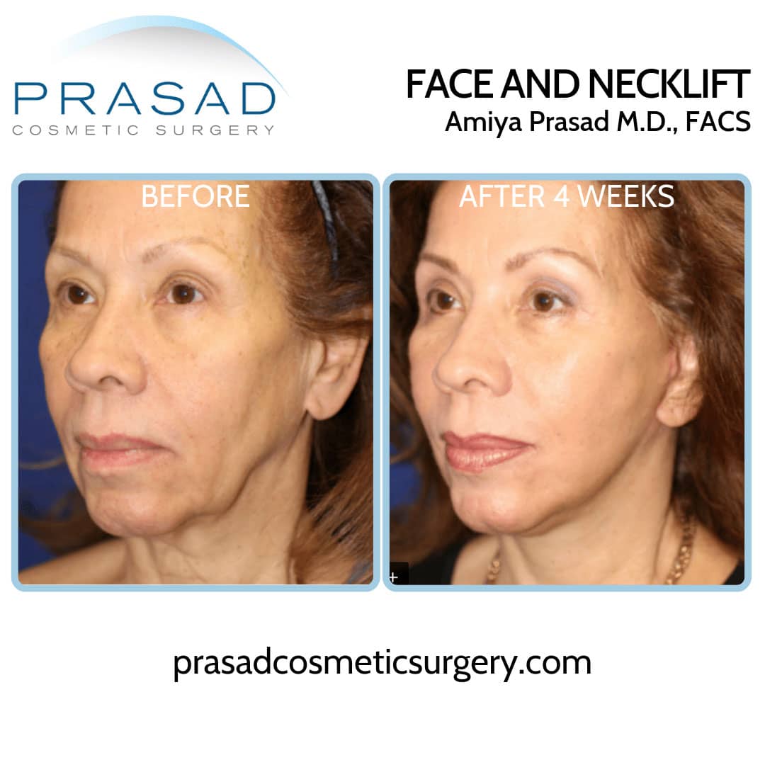 Neck lift recovery week by week  Yates Institute of Plastic Surgery