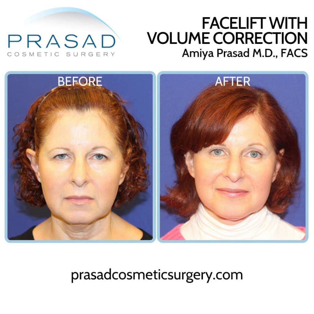facelift surgery with facial volume correction before and after recovery