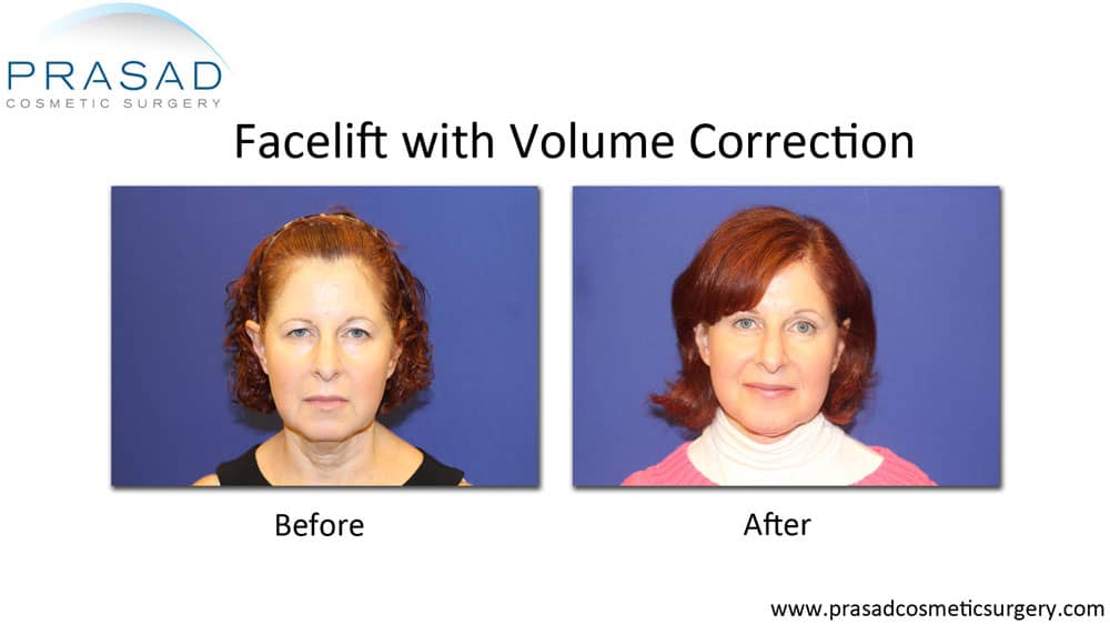 facelift with facial volume correction before and after recovery
