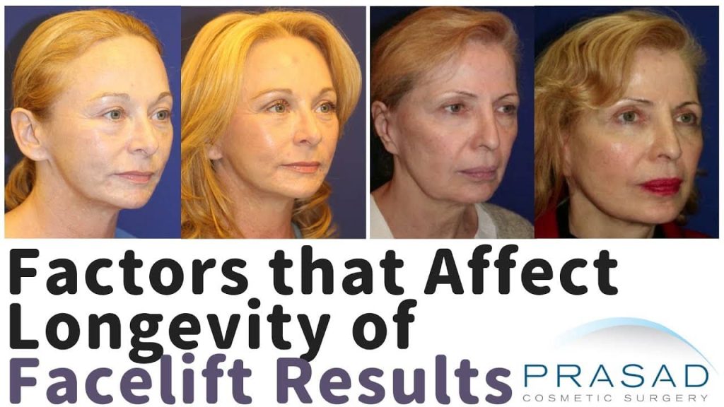 how long do facelifts last - facelifts before and after
