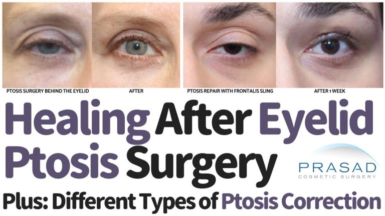 what is healing like after ptosis surgery