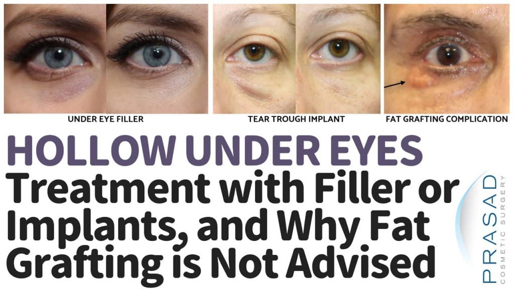 hollow under eyes treatment with filler or tear trough implants