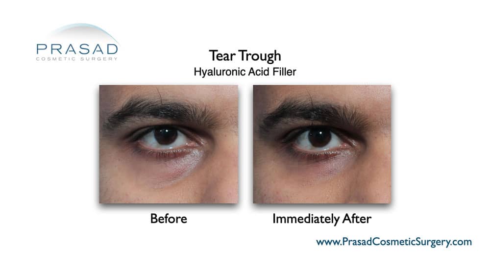 Under Eye Fat Transfer: Possible Complications & Safer Alternative