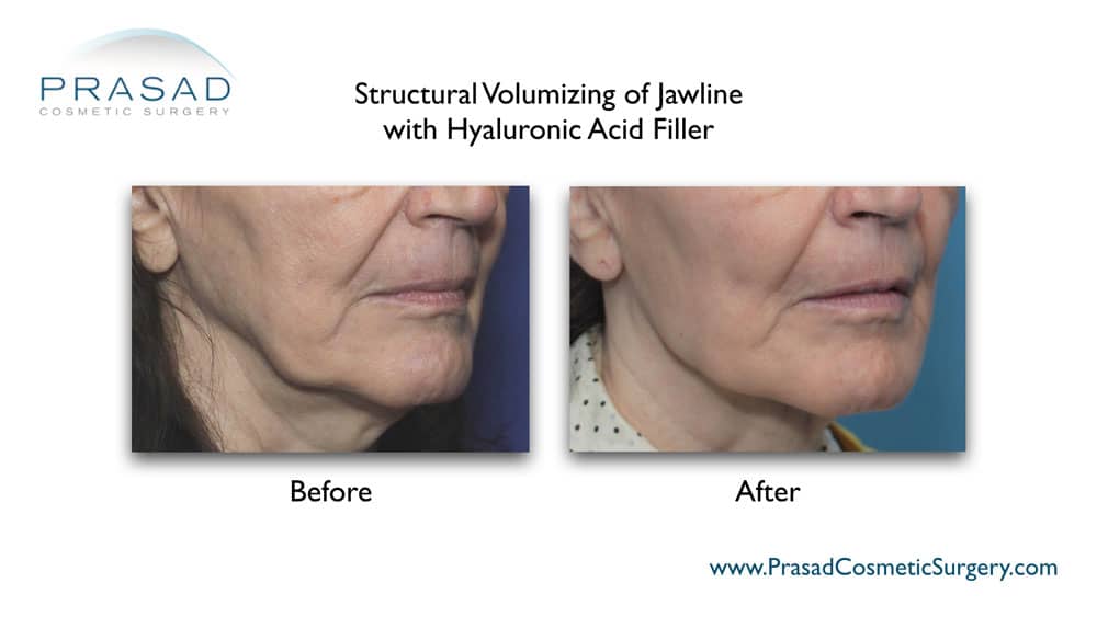 hyaluronic acid fillers for jawline before and after