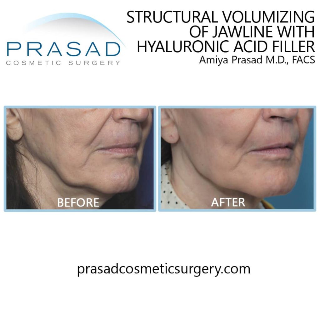 Under Eye Filler Before and After Photos - Prasad Cosmetic Surgery NY