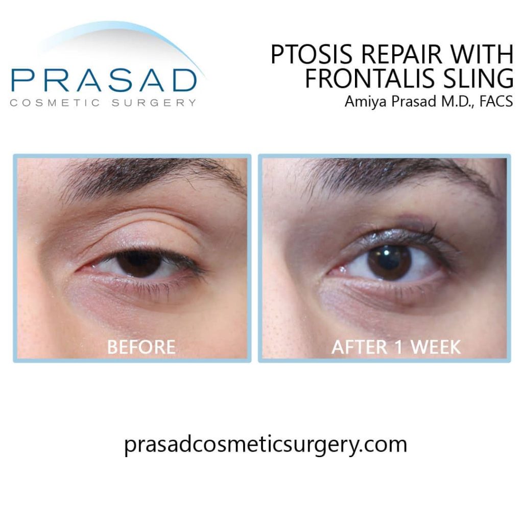 what is healing like after ptosis repair before and after 1 week
