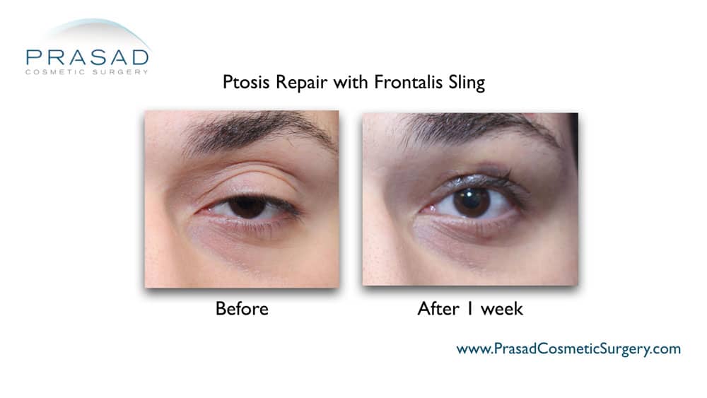 Healing After Ptosis Surgery | Dr. Prasad Blog