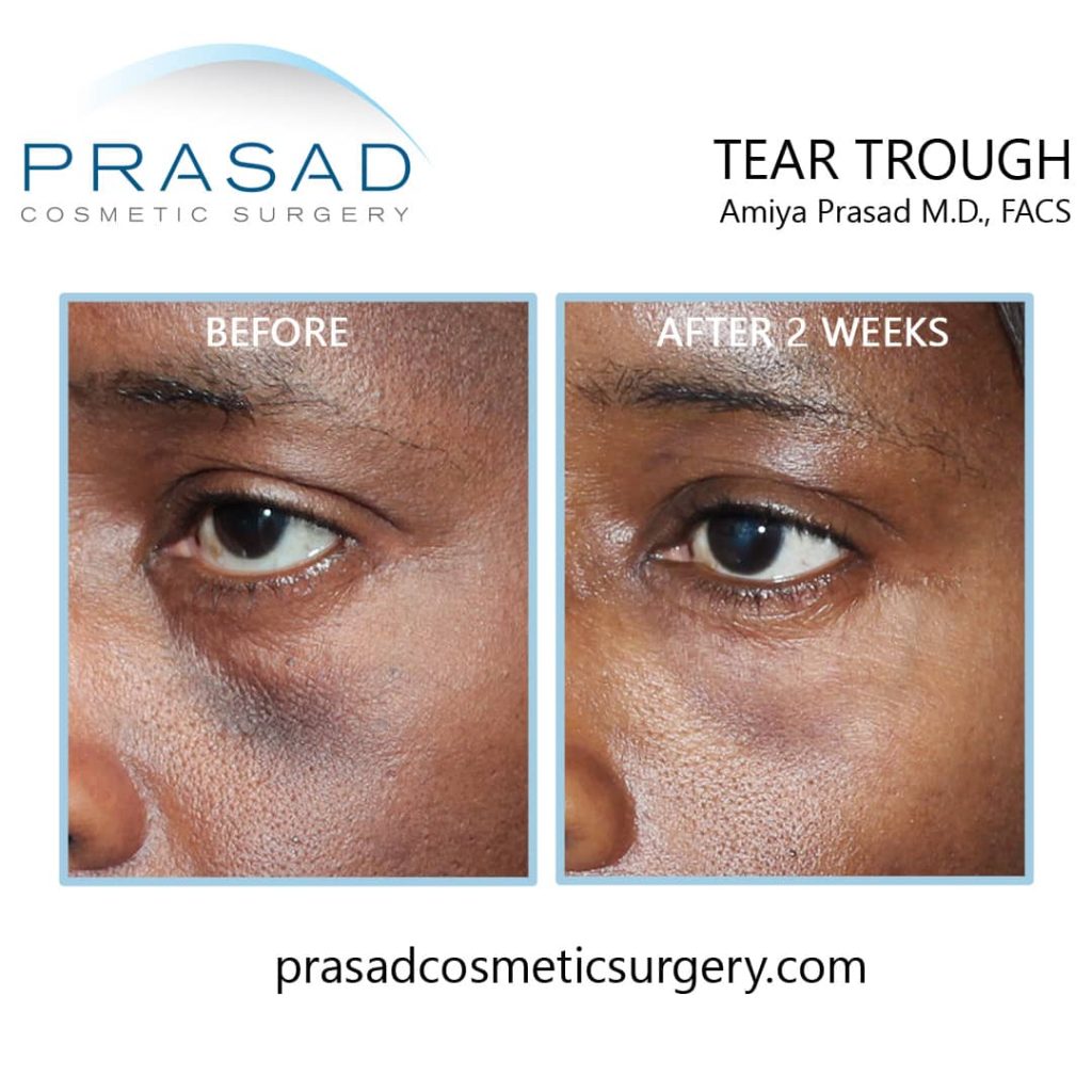 under eye hollow treatment before and after on dark skin patient