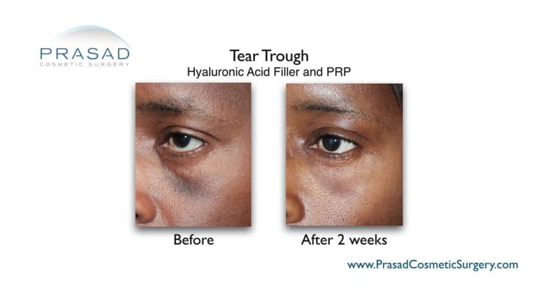What is the Best Treatment for Under Eye Hollows? | Dr. Prasad Blog