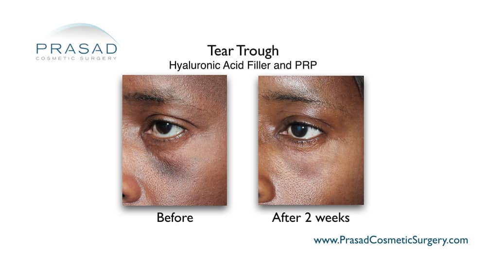 best under eye hollow treatment before and after