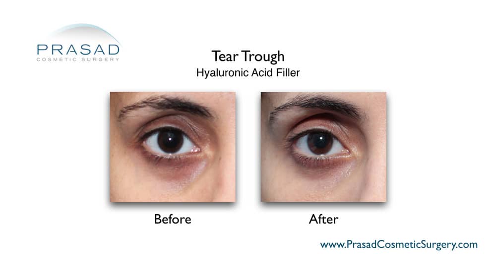 What is the Best Treatment for Under Eye Hollows? | Dr. Prasad Blog