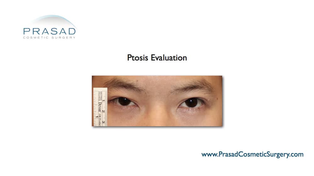 eyelid ptosis eye examination