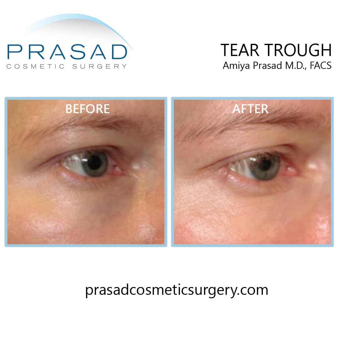 Under Eye Filler Before and After Photos - Prasad Cosmetic Surgery NY