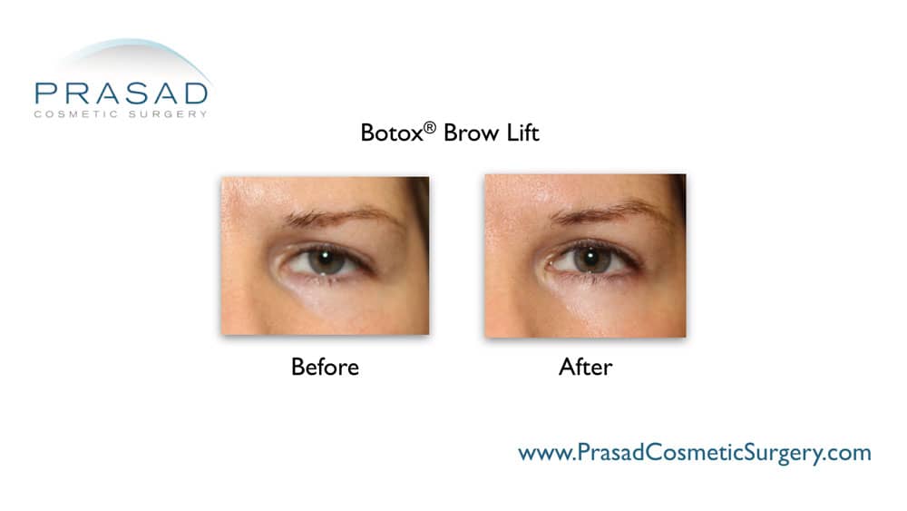 Droopy eyelid Botox treatment before and after