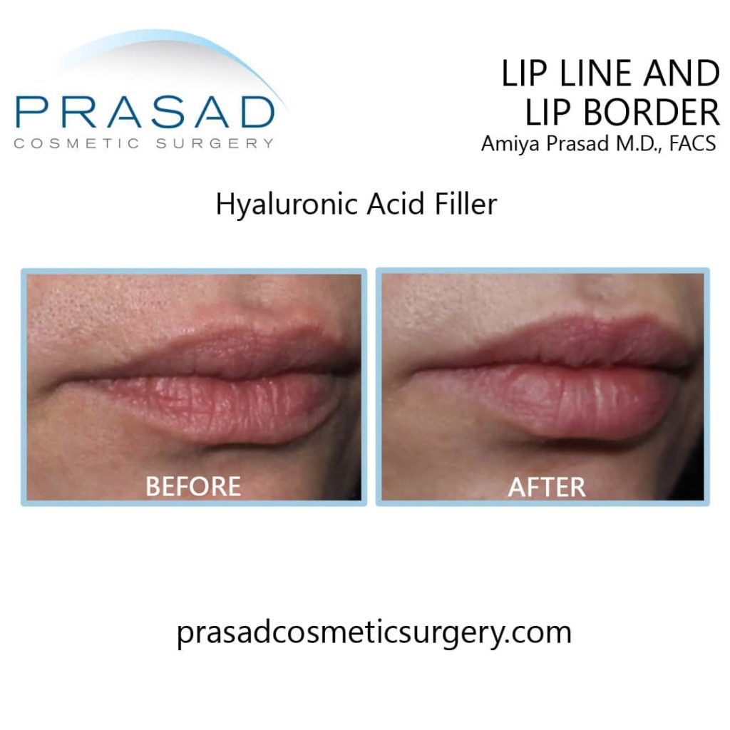 lines around mouth fillers before and after