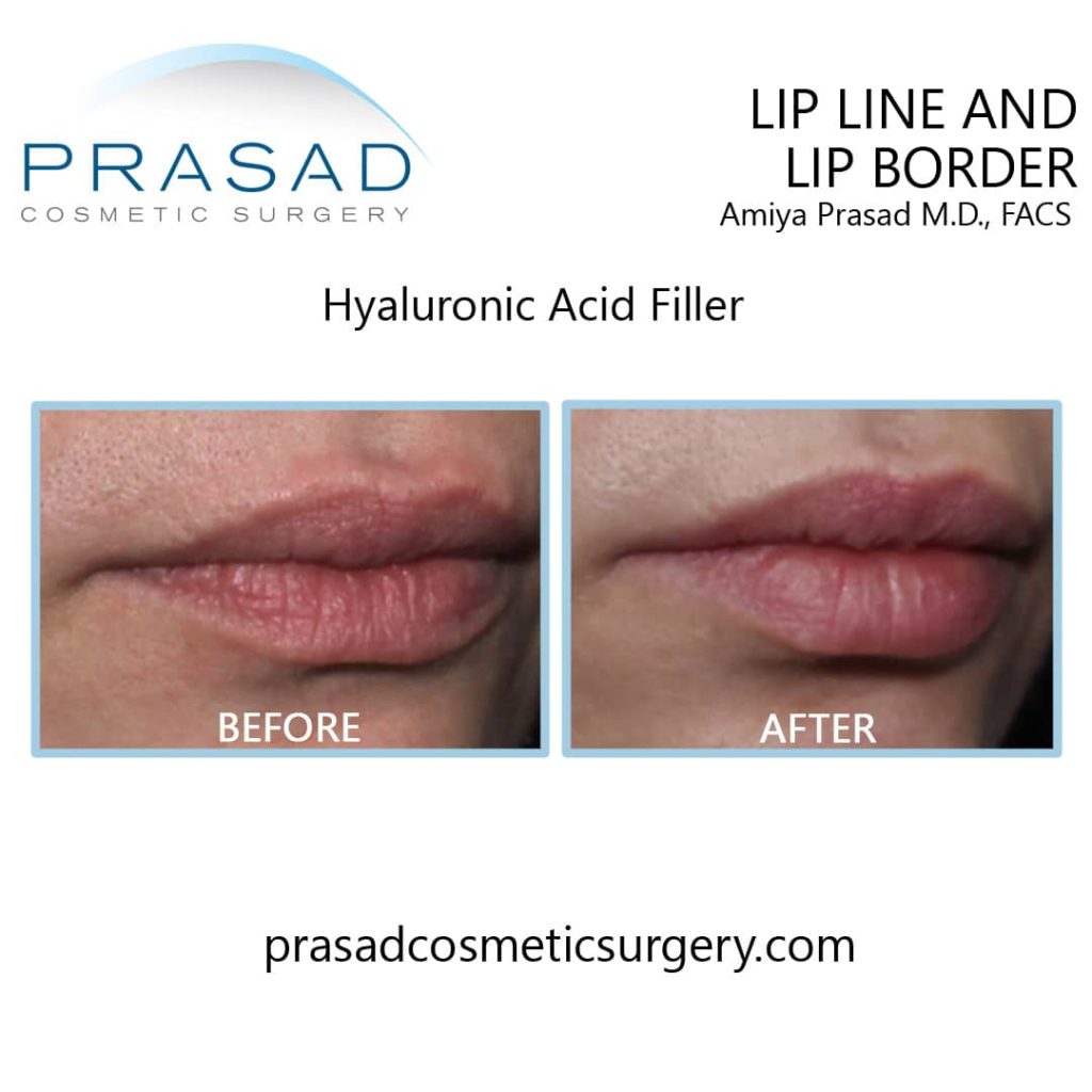 https://prasadcosmeticsurgery.com/wp-content/uploads/2022/05/Lip-line-and-lip-border-with-hyaluronic-acid-filler-1-1024x1024.jpg