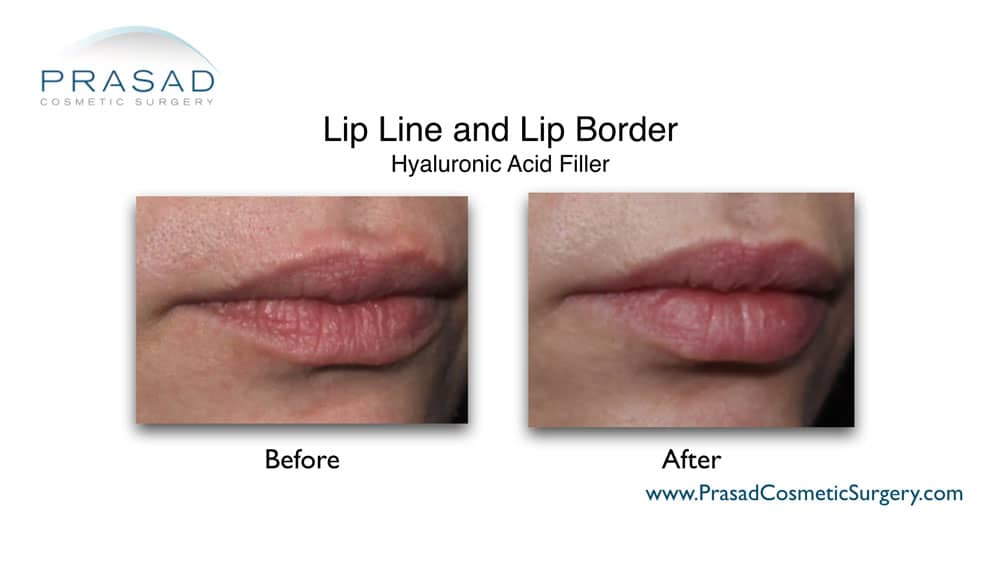 fillers for lip lines before and after