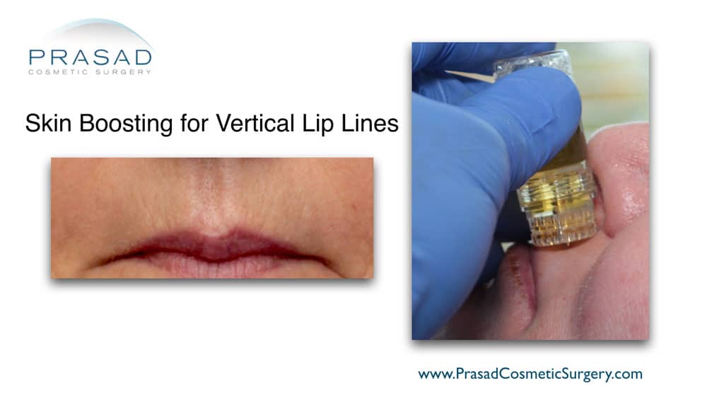 skin boosting - non-surgical treatment for upper lip lines