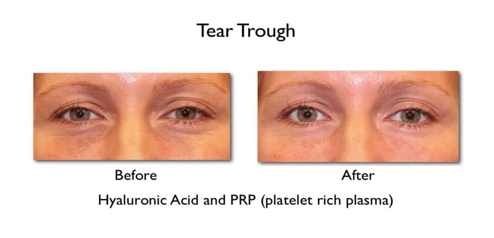 under eye filler for wrinkles before and after