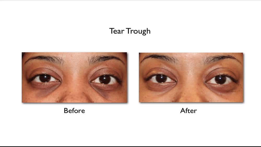 dermal filler under eyes before and after