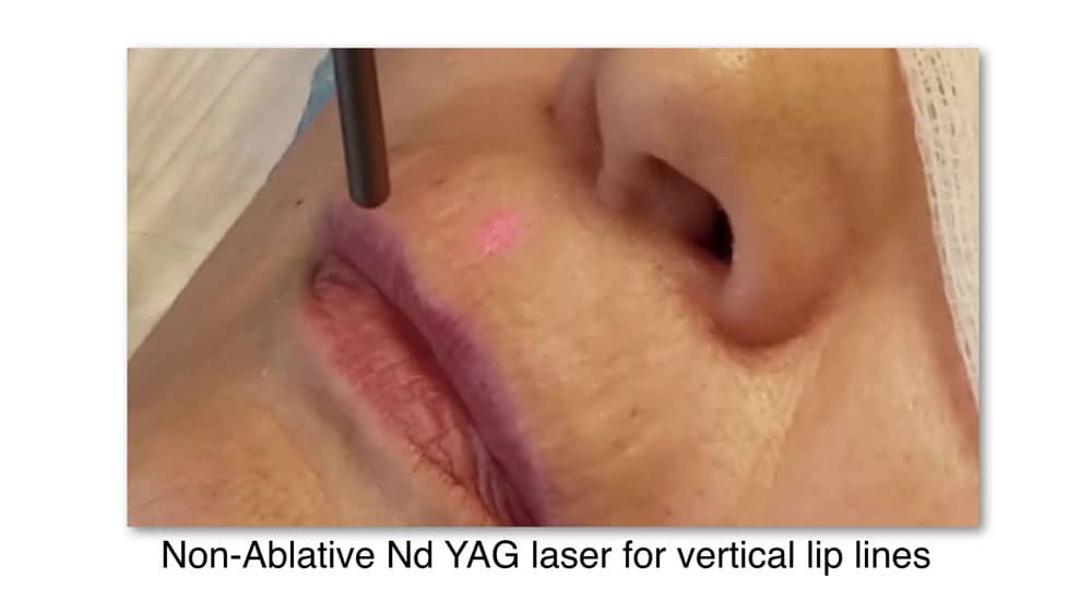laser for vertical lip lines treatment