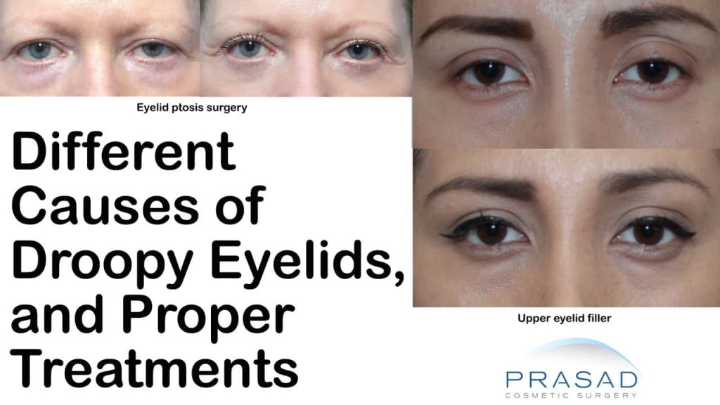what causes a droopy eyel and proper treatments
